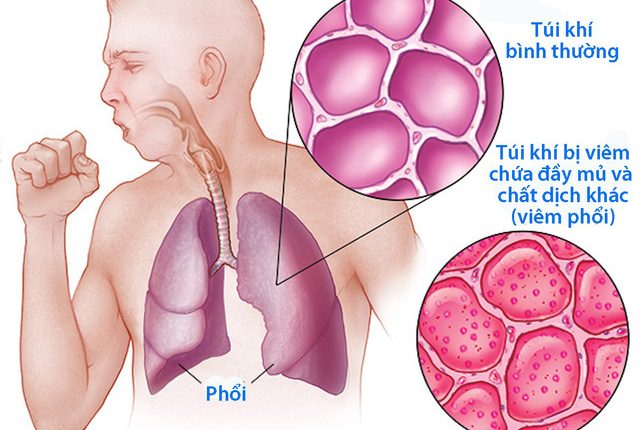 phổi lạnh